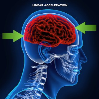 La aceleración lineal y su impacto en la cabeza del piloto